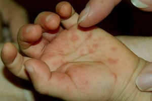 В Ростове энтеровирусной инфекцией заболели 11 детей